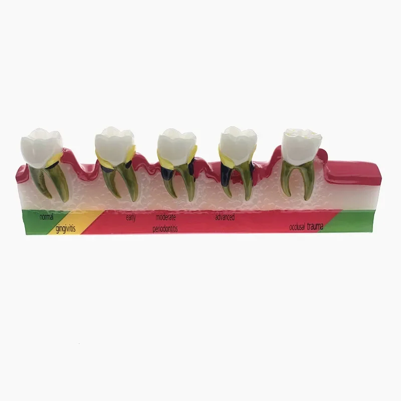 5-Stage Dental Teeth Model - Periodontal Disease Demonstration Tool for Dentist Training & Patient Education
5-Stage Dental Teeth Model - Periodontal Disease Demonstration Tool for Dentist Training & Patient Education