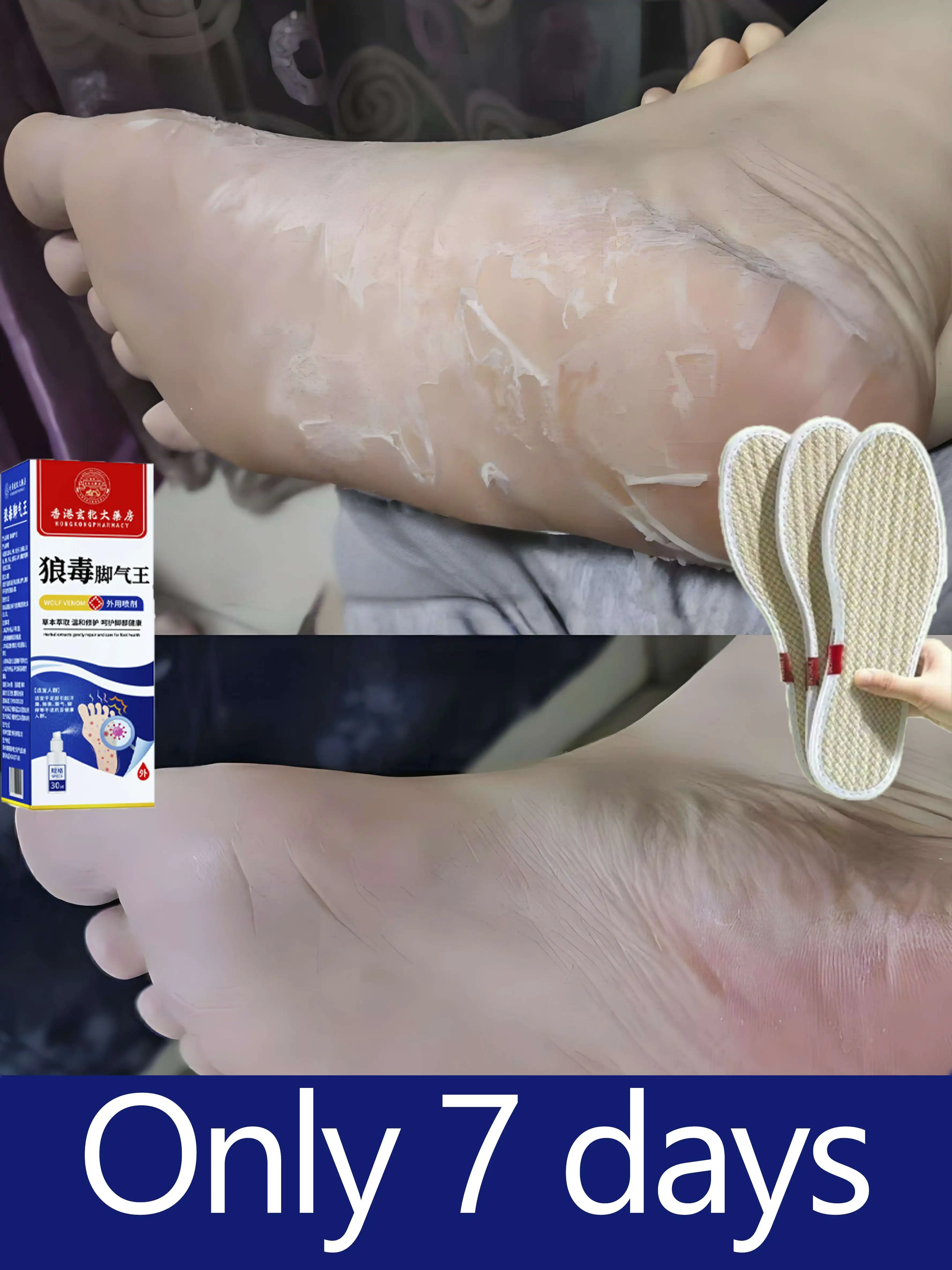 Быстродействующее устройство грибка ног — попрощайтесь на зуд и отшелушивание
Быстродействующее устройство грибка ног — попрощайтесь на зуд и отшелушивание 