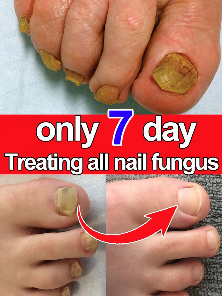 7 days nail fungus treatment essence oil toenail fungus removal essence repair onychomycosis anti-infection gel care product
7 days nail fungus treatment essence oil toenail fungus removal essence repair onychomycosis anti-infection gel care product