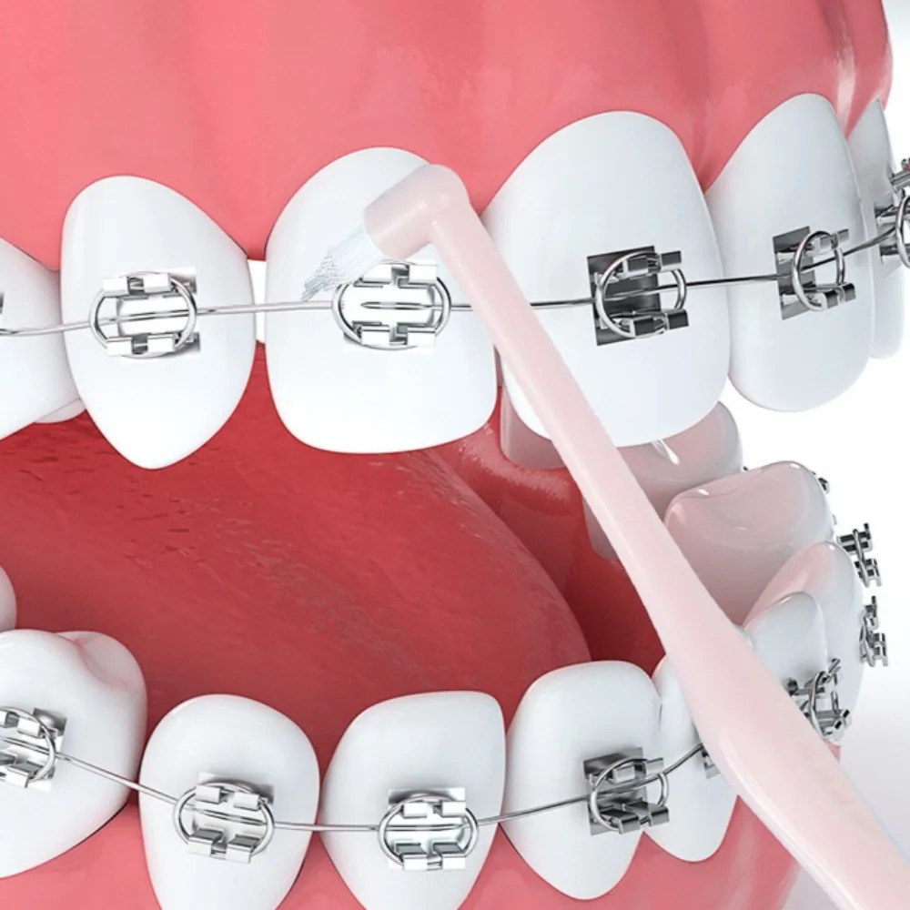 1/2 шт., однолучевая мягкая зубная щетка для чистки зубов с маленькой головкой, ортодонтическая межзубная щетка, мягкий имплантат волос, инструмент для ухода за полостью рта для взрослых
1/2 шт., однолучевая мягкая зубная щетка для чистки зубов с маленькой головкой, ортодонтическая межзубная щетка, мягкий имплантат волос, инструмент для ухода за полостью рта для взрослых