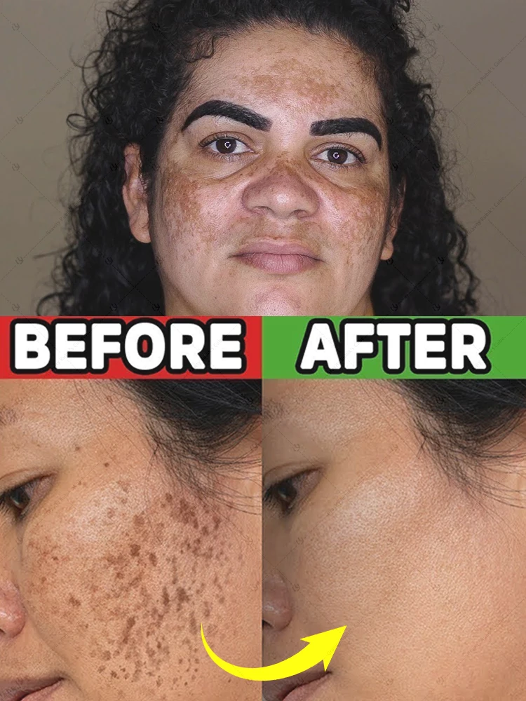 18 years younger, deeply eliminates dark spots on the face 
18 years younger, deeply eliminates dark spots on the face