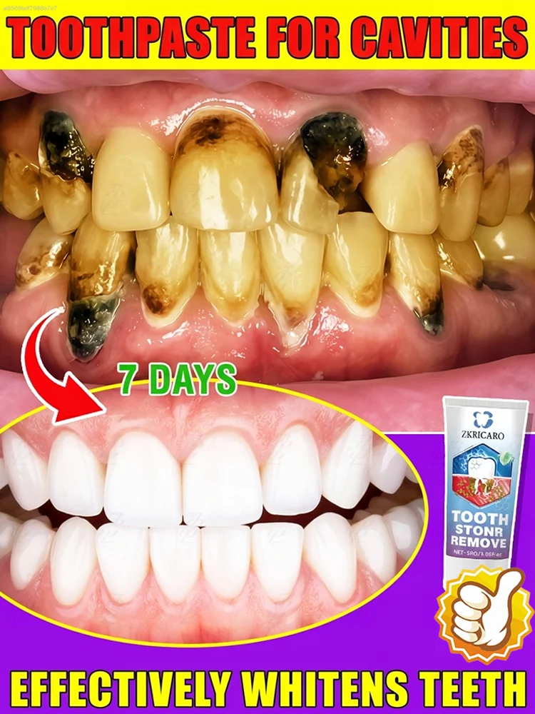 No Doctor Needed! Repair Cavities, Black Teeth, and Yellow Teeth at Home
No Doctor Needed! Repair Cavities, Black Teeth, and Yellow Teeth at Home