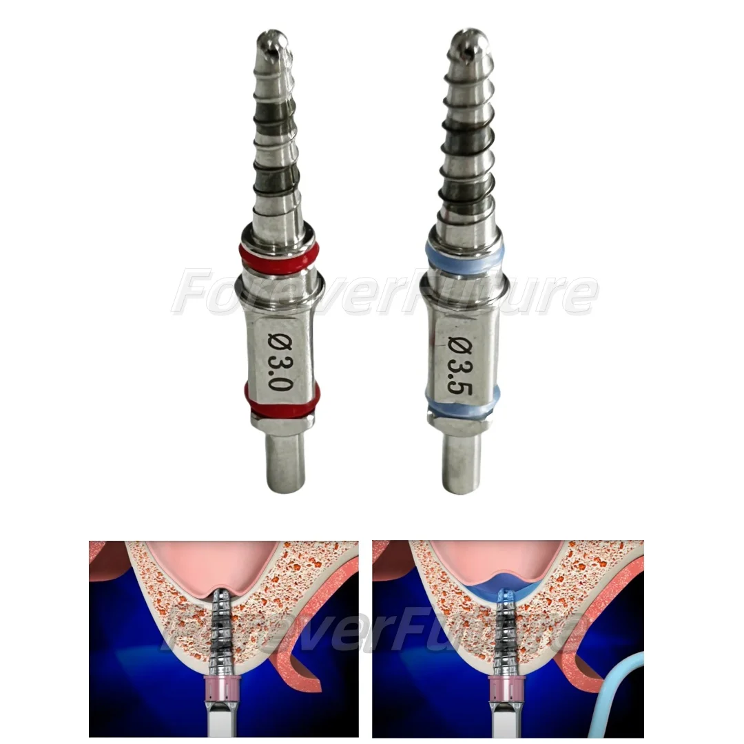 Dental Water Rising Hydraulic Membrane Lifter Drill Hiossen Sinus Lift Drills 3.0mm/3.5mm
Dental Water Rising Hydraulic Membrane Lifter Drill Hiossen Sinus Lift Drills 3.0mm/3.5mm