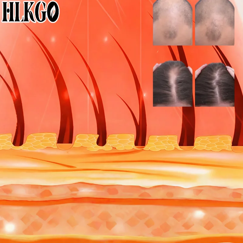 300 Diodes 650nm Red Laser Hair Cap for Hair Regrowth Anti Hair Loss Scalp Relax Care Therapy
300 Diodes 650nm Red Laser Hair Cap for Hair Regrowth Anti Hair Loss Scalp Relax Care Therapy