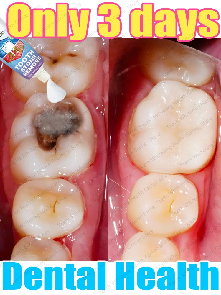 Contains probiotics to repair tooth decay and clean teeth
Contains probiotics to repair tooth decay and clean teeth