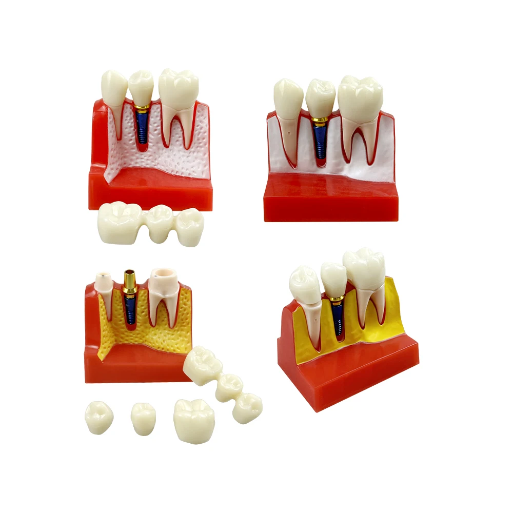 Стоматологическая модель зубов-имплантатов 4-кратного увеличения, съемная модель зубов из смолы для обучения, изучения коронок и мостов, инструмент для стоматологов
Стоматологическая модель зубов-имплантатов 4-кратного увеличения, съемная модель зубов из смолы для обучения, изучения коронок и мостов, инструмент для стоматологов