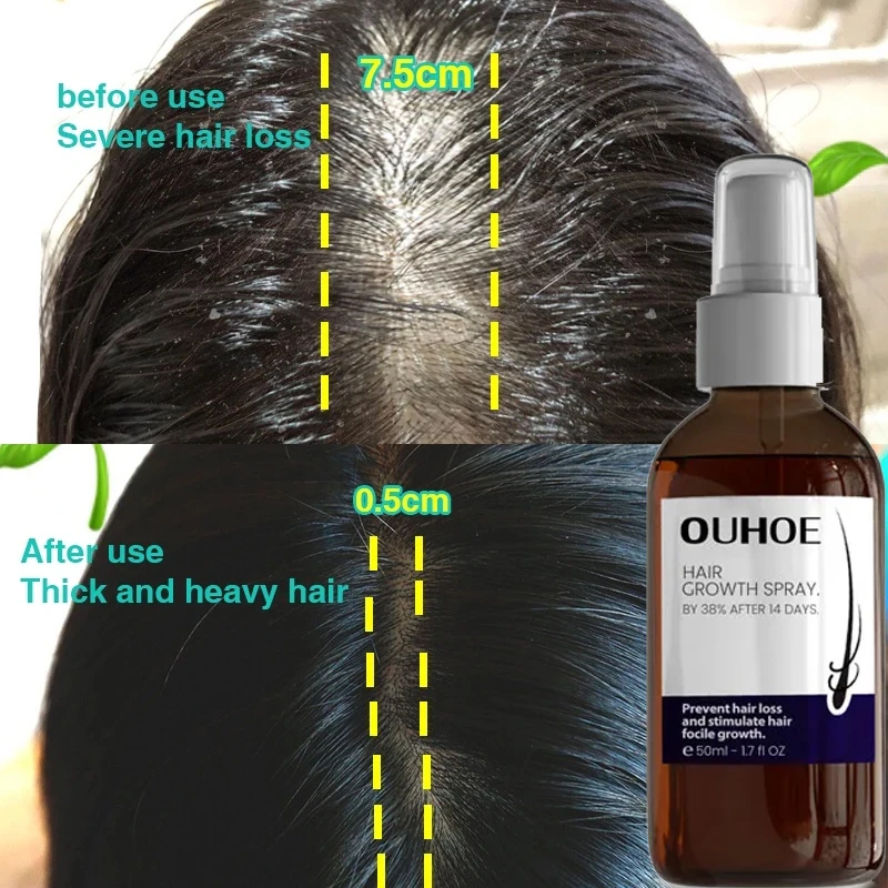 50ml Hair Growth Spray Prevent Hair Loss Fast Growing Hair Care Essential Oil Repair Damaged Beauty Health Product for Men Women
50ml Hair Growth Spray Prevent Hair Loss Fast Growing Hair Care Essential Oil Repair Damaged Beauty Health Product for Men Women