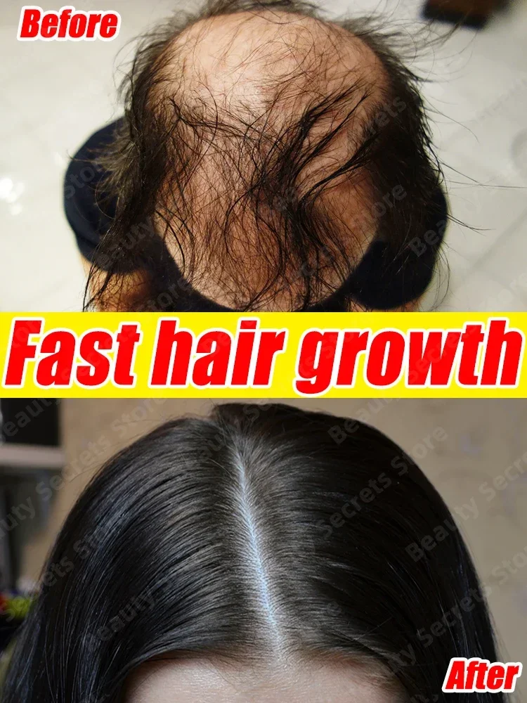 O óleo de crescimento capilar faz o cabelo crescer rapidamente, repara eficazmente a calvície e a queda de cabelo hereditária
O óleo de crescimento capilar faz o cabelo crescer rapidamente, repara eficazmente a calvície e a queda de cabelo hereditária