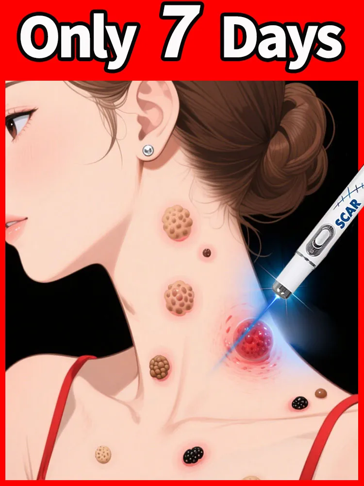 New Upgrade Blue Laser Solve Wart Tool 2025
New Upgrade Blue Laser Solve Wart Tool 2025