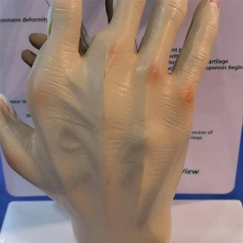 ABTS-Osteoarthritis Hand Model, Model Of Hand Pathology, Human Anatomy And Physiology Replica, 's Office Anatomy Model
ABTS-Osteoarthritis Hand Model, Model Of Hand Pathology, Human Anatomy And Physiology Replica, 's Office Anatomy Model