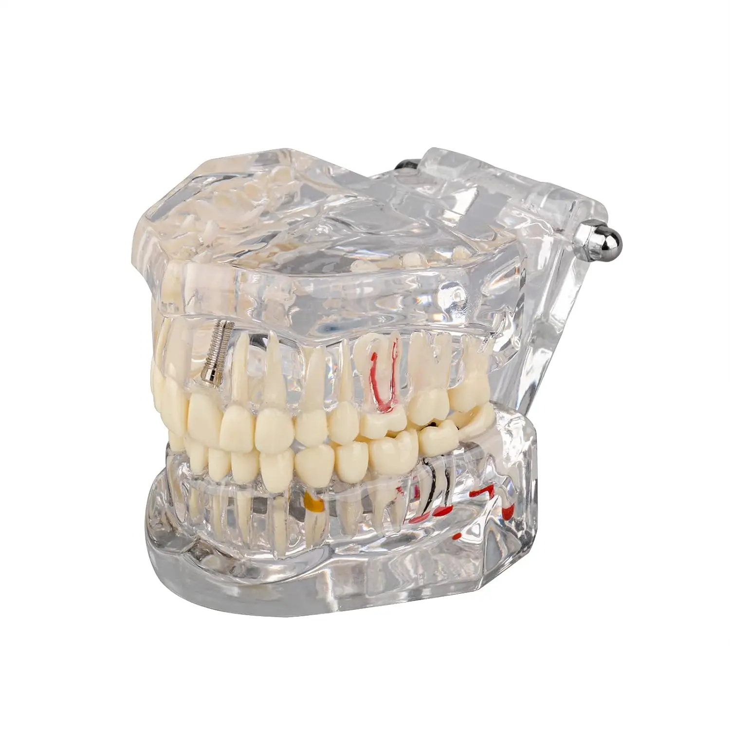 Dental Transparent Disease Teeth Model With Removable Restoration Bridge Tooth Model Teaching Research
Dental Transparent Disease Teeth Model With Removable Restoration Bridge Tooth Model Teaching Research