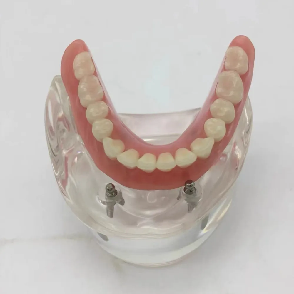 2/4 Implants Overdenture Model Upper/Lower Jaw Removable Denture Model for Dentistry Study Teaching Demonstration Study Tools
2/4 Implants Overdenture Model Upper/Lower Jaw Removable Denture Model for Dentistry Study Teaching Demonstration Study Tools
