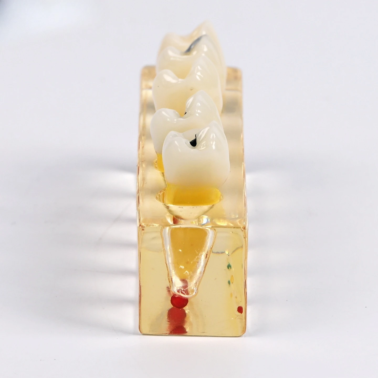 Dentals pathological treatment model dentals caries disease model
Dentals pathological treatment model dentals caries disease model