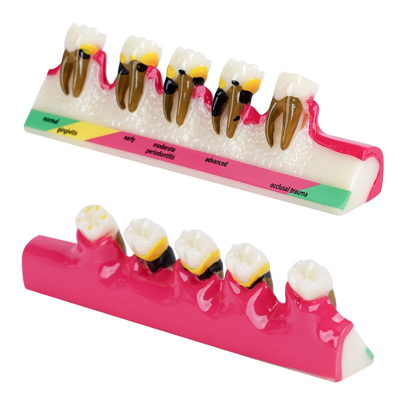 5-Stage Teeth Periodontal Disease Model Evolutionary Caries Classification Presentation Dental Patient Teaching Demonstration
5-Stage Teeth Periodontal Disease Model Evolutionary Caries Classification Presentation Dental Patient Teaching Demonstration