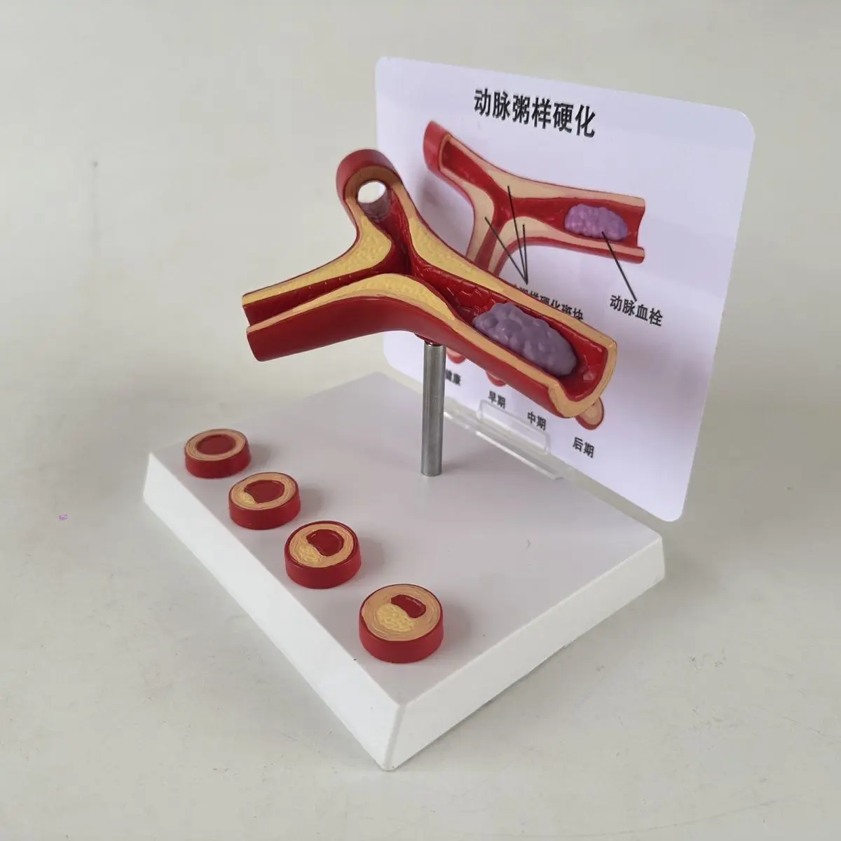 Fork like vessel model Dynamic trigeminal thrombus occlusion model Human simulated vascular atherosclerosis
Fork like vessel model Dynamic trigeminal thrombus occlusion model Human simulated vascular atherosclerosis