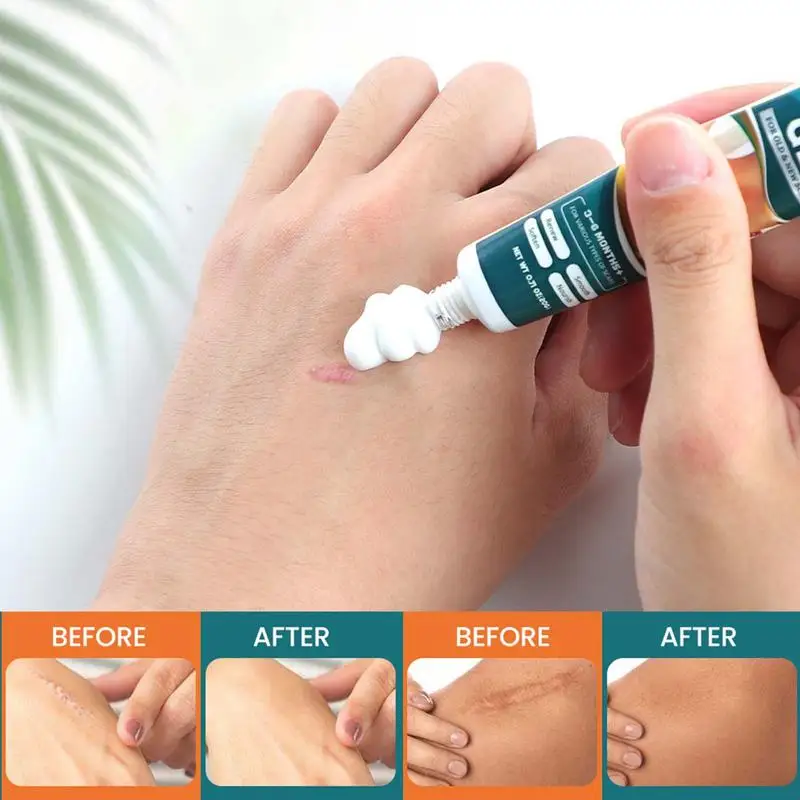 Scar Removal Cream Scar Gel Soothing Ointment Itch Relief Gel Cuts Burns Skincare Natural Ointment Stretch Mark Remover Scar
Scar Removal Cream Scar Gel Soothing Ointment Itch Relief Gel Cuts Burns Skincare Natural Ointment Stretch Mark Remover Scar