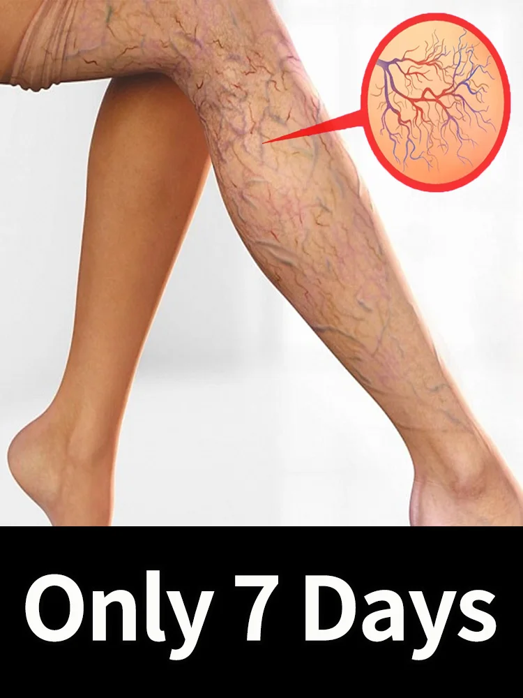 Leg care tools, spider leg, varicose veins, painless blue light treatment
Leg care tools, spider leg, varicose veins, painless blue light treatment