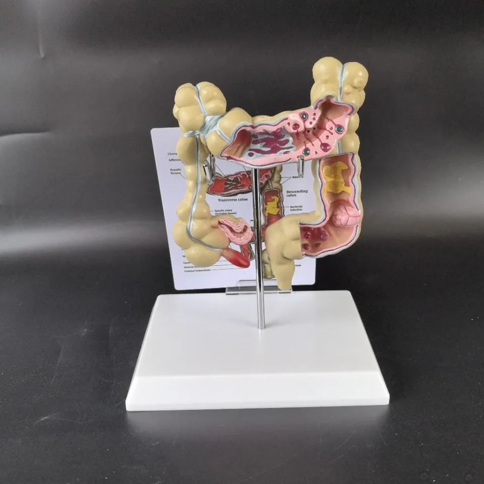 Human colon pathology teaching model, medical clear anatomy model of large intestine
Human colon pathology teaching model, medical clear anatomy model of large intestine