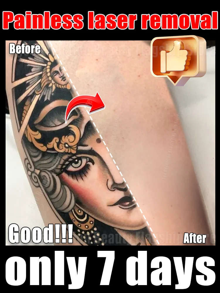 Hot-selling products in 2025:Pᴀɪɴʟᴇss ᴛᴀᴛᴛᴏᴏ ʀᴇᴍᴏᴠᴀʟ ʟᴀsᴇʀ ᴘᴇɴ,ʙʟᴜᴇ ʟᴀsᴇʀ ᴜᴘɢʀᴀᴅᴇᴅ ᴛᴏ ᴛʜᴇ sᴇᴄᴏɴᴅ ɢᴇɴᴇʀᴀᴛɪᴏɴ
Hot-selling products in 2025:Pᴀɪɴʟᴇss ᴛᴀᴛᴛᴏᴏ ʀᴇᴍᴏᴠᴀʟ ʟᴀsᴇʀ ᴘᴇɴ,ʙʟᴜᴇ ʟᴀsᴇʀ ᴜᴘɢʀᴀᴅᴇᴅ ᴛᴏ ᴛʜᴇ sᴇᴄᴏɴᴅ ɢᴇɴᴇʀᴀᴛɪᴏɴ