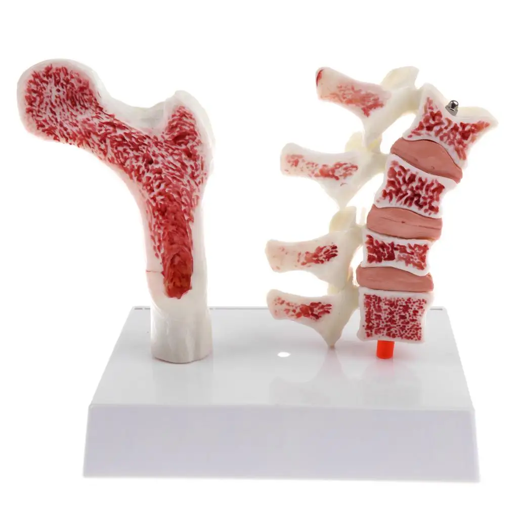 1:1 Human Vertebra Thighbone Osteoporosis Pathology Model School Teaching Display
1:1 Human Vertebra Thighbone Osteoporosis Pathology Model School Teaching Display