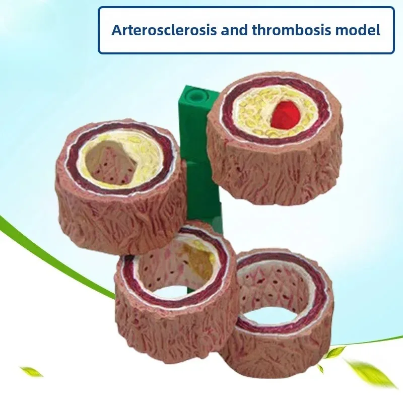 Anatomy Four Stage Pathological Vascular Model Occlusion Atherosclerosis Cardiovascular Artery Thrombosis Medical Teaching Tool
Anatomy Four Stage Pathological Vascular Model Occlusion Atherosclerosis Cardiovascular Artery Thrombosis Medical Teaching Tool