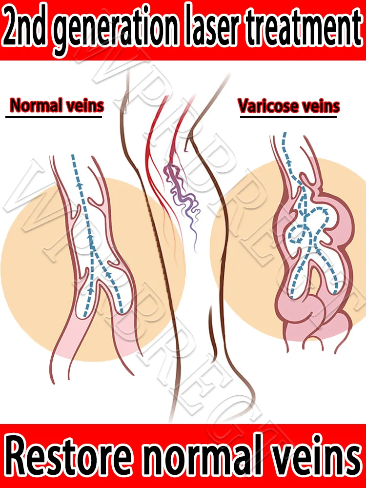 Лазерное лечение варикозного расширения вен
Лазерное лечение варикозного расширения вен