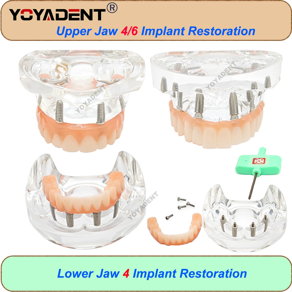 Dental Model Implant Teeth Model Transparent Upper/Lower Jaw Type Overdenture With 4/6 Removable Implant Screws Maryland Bridge
Dental Model Implant Teeth Model Transparent Upper/Lower Jaw Type Overdenture With 4/6 Removable Implant Screws Maryland Bridge