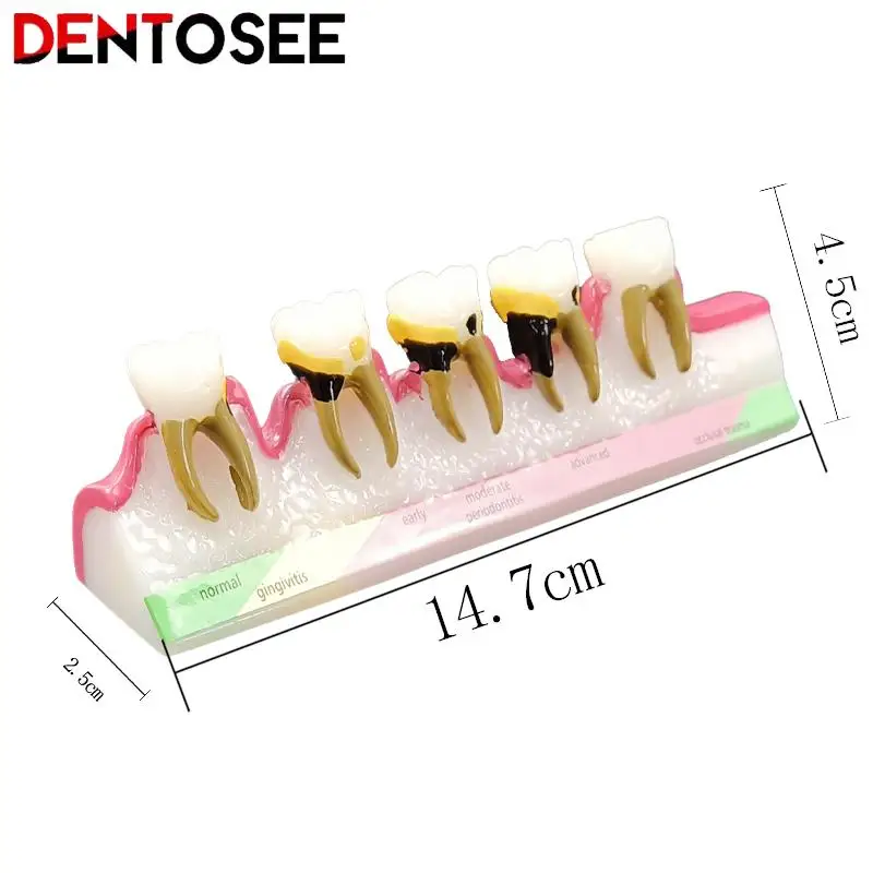 Dental Periodontal Disease Assort Demo Teeth Model 5 Stage Three-Dimensional Proportional Magnification Design for Dentist
Dental Periodontal Disease Assort Demo Teeth Model 5 Stage Three-Dimensional Proportional Magnification Design for Dentist