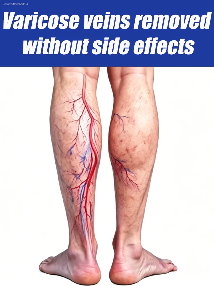leg care tools Say goodbye to leg discomfort Spider Legs Relieve leg pressure
leg care tools Say goodbye to leg discomfort Spider Legs Relieve leg pressure