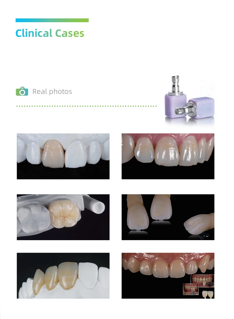 Dental Lithium Disilicate C14 Glass Ceramic Bloek Processing of Dental Veneers, Crowns and Complete Dentures
Dental Lithium Disilicate C14 Glass Ceramic Bloek Processing of Dental Veneers, Crowns and Complete Dentures