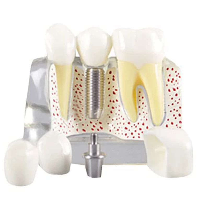 Teeth Demonstration Model Implant Removable Analysis Crown Bridge For -Patient Communication
Teeth Demonstration Model Implant Removable Analysis Crown Bridge For -Patient Communication