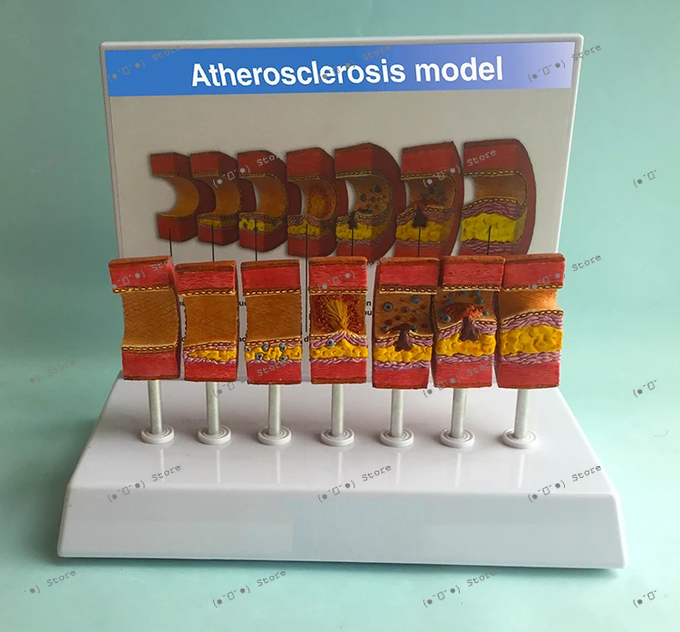 Vascular Model Atherosclerosis Model Thromboembolism Model Lipid Vascular Blockage
Vascular Model Atherosclerosis Model Thromboembolism Model Lipid Vascular Blockage