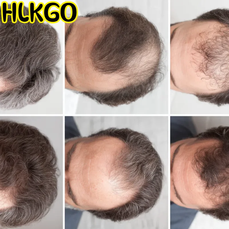 Шапочка для роста волос с 96 диодами, 650 нм, 5 МВт, LLLT, терапия красным светом для профессионального лечения выпадения волос
Шапочка для роста волос с 96 диодами, 650 нм, 5 МВт, LLLT, терапия красным светом для профессионального лечения выпадения волос