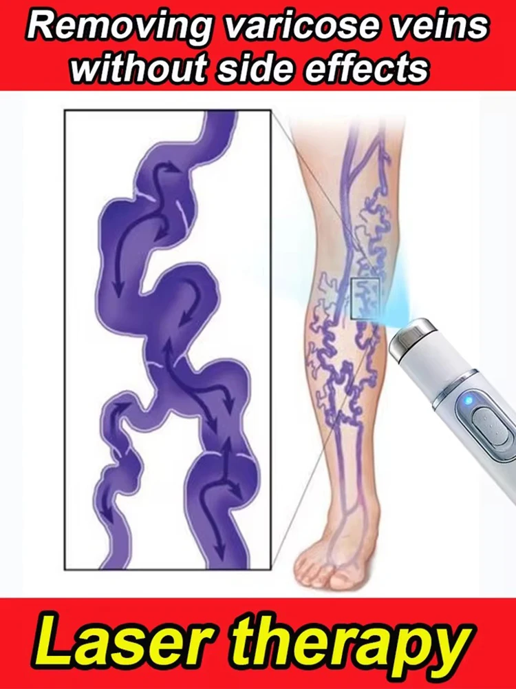 Spider legs varicose veins disappear
Spider legs varicose veins disappear