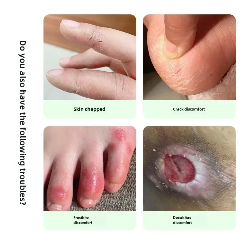 Skin External Health Cream 30g Chapped Skin Frostbite Bedsores Uncomfortable Body Care Cream
Skin External Health Cream 30g Chapped Skin Frostbite Bedsores Uncomfortable Body Care Cream