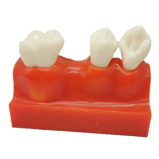 1 pc Decorative Analysis Model Crown Bridge Demonstration Teaching Model, Removable Training Study, 4 Times
1 pc Decorative Analysis Model Crown Bridge Demonstration Teaching Model, Removable Training Study, 4 Times