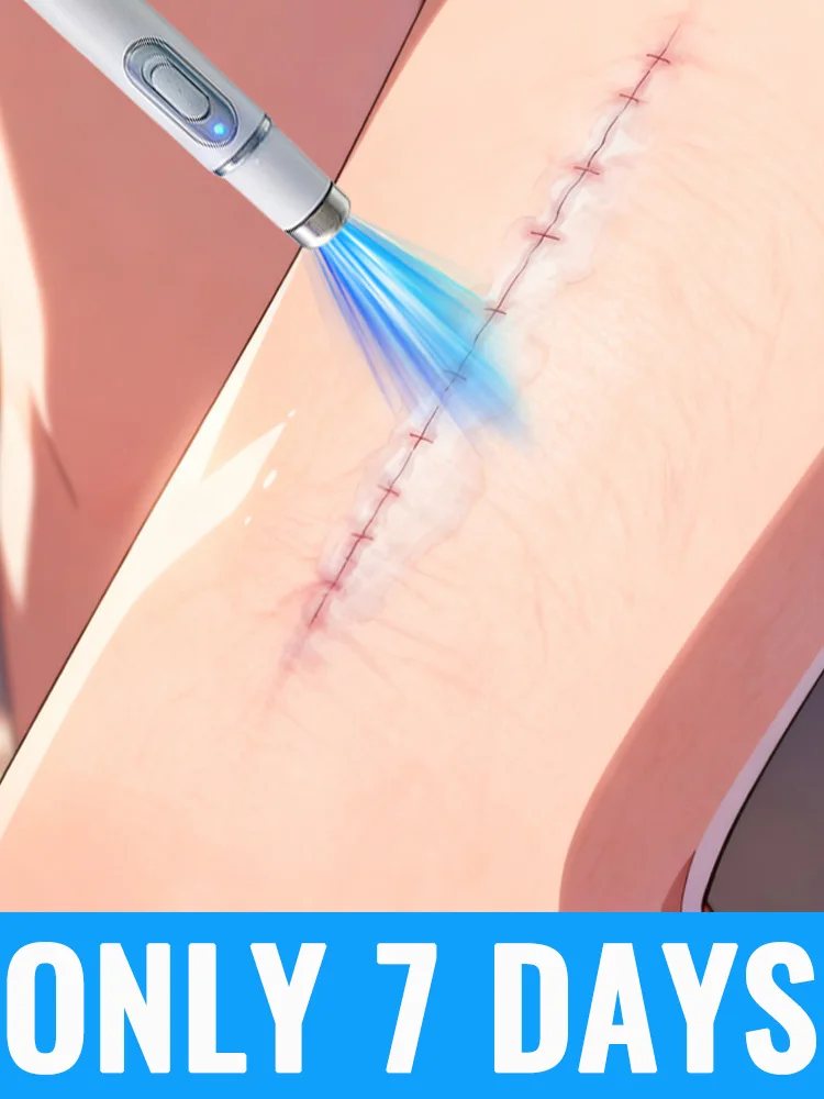 Generation-2 Laser Says Goodbye To all scars In 7 Days
Generation-2 Laser Says Goodbye To all scars In 7 Days