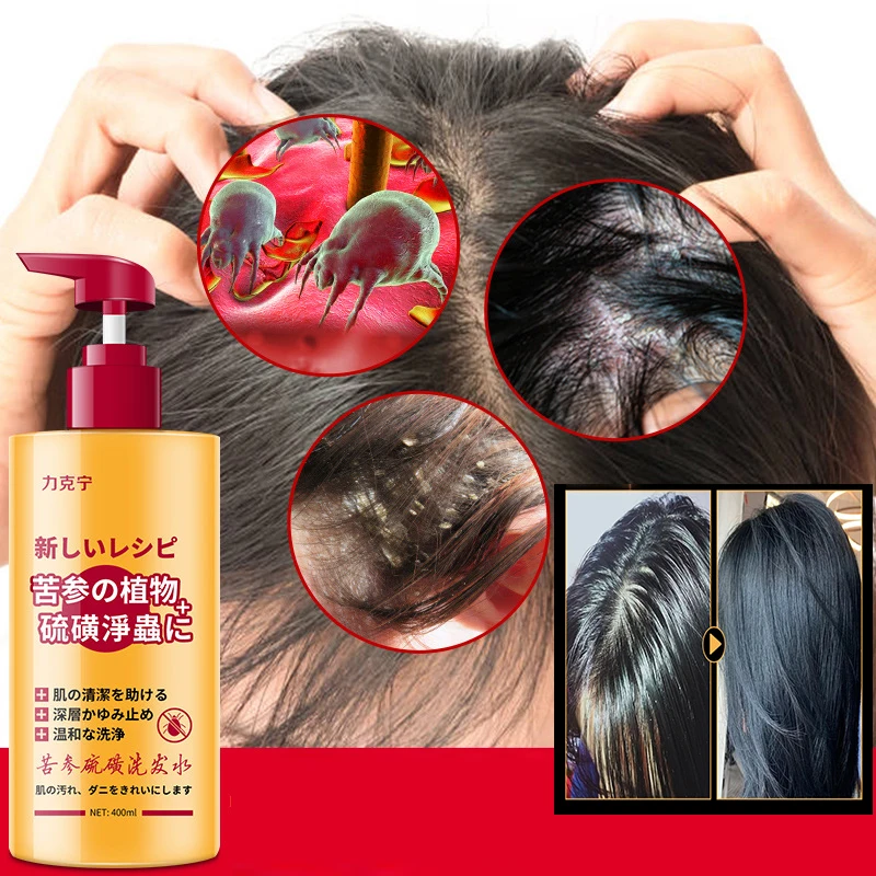 400ml Radix Sophorae Flavescentis Sulfur Shampoo for Removing Mites Dandruff Relieving Itching and Seborrheic Sulphur Shampoo
400ml Radix Sophorae Flavescentis Sulfur Shampoo for Removing Mites Dandruff Relieving Itching and Seborrheic Sulphur Shampoo