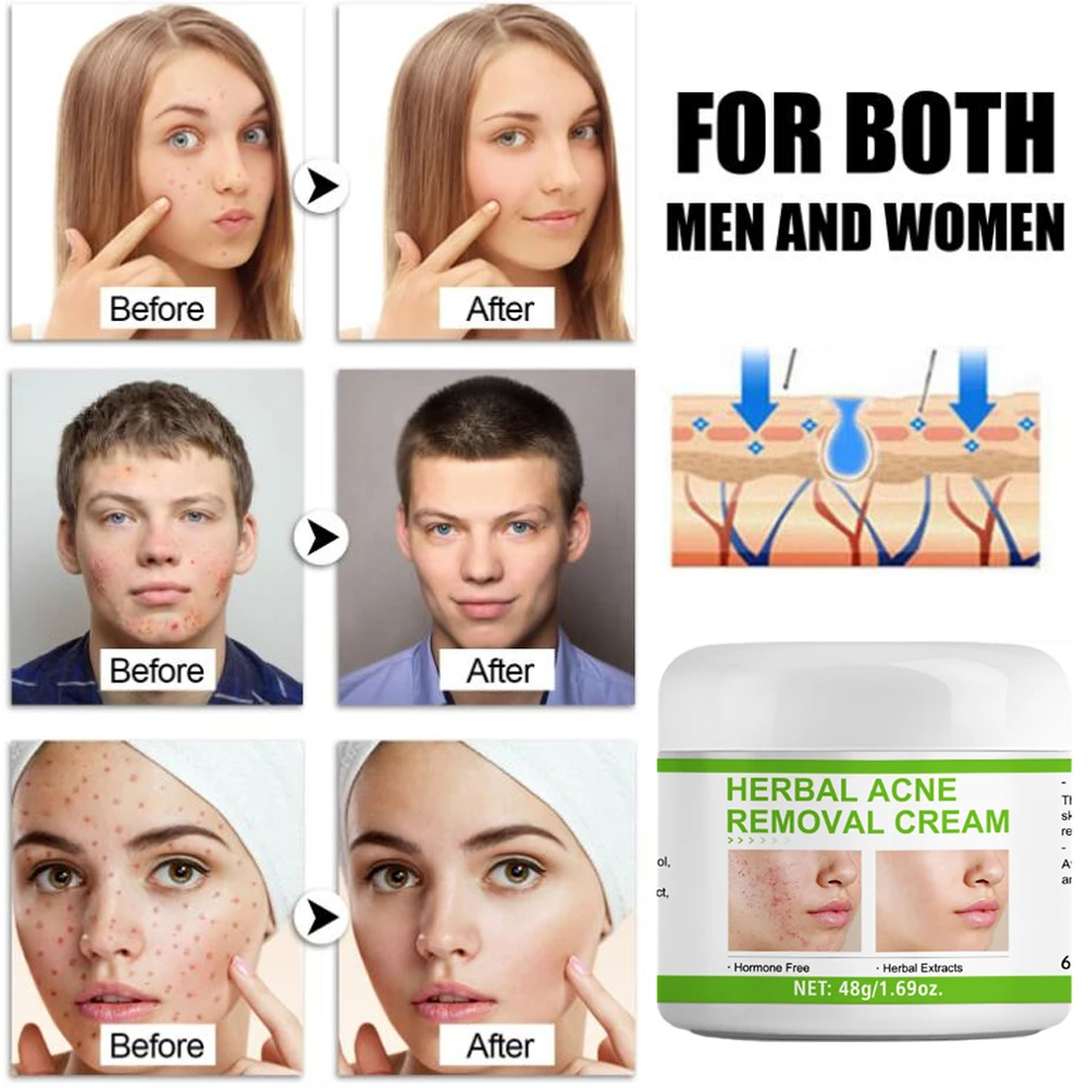 Jemeesen Acne Removal Face Cream Control Anti-Acne CreamTreatment Acne Mark Skin Care Whitening Eliminate Pimples Facial Cream
Jemeesen Acne Removal Face Cream Control Anti-Acne CreamTreatment Acne Mark Skin Care Whitening Eliminate Pimples Facial Cream