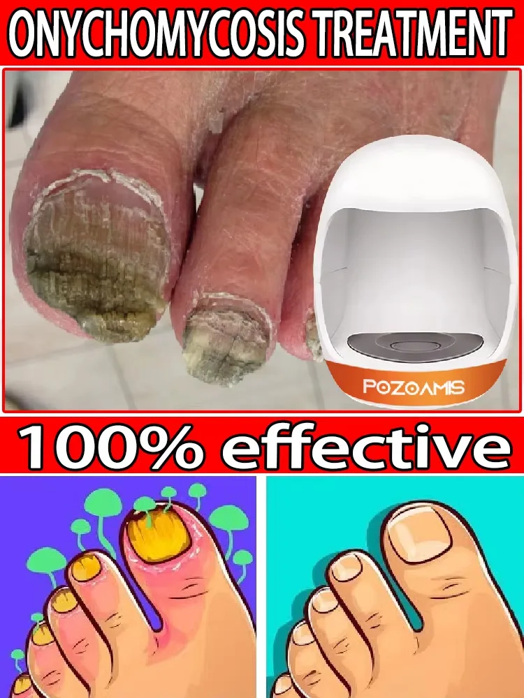 Extra Strong Nail Fungus Treatment Serum Essence oil Laser Pen Therapy Feet Nails Repair Care Anti Infection Toe Fungal Removal
Extra Strong Nail Fungus Treatment Serum Essence oil Laser Pen Therapy Feet Nails Repair Care Anti Infection Toe Fungal Removal