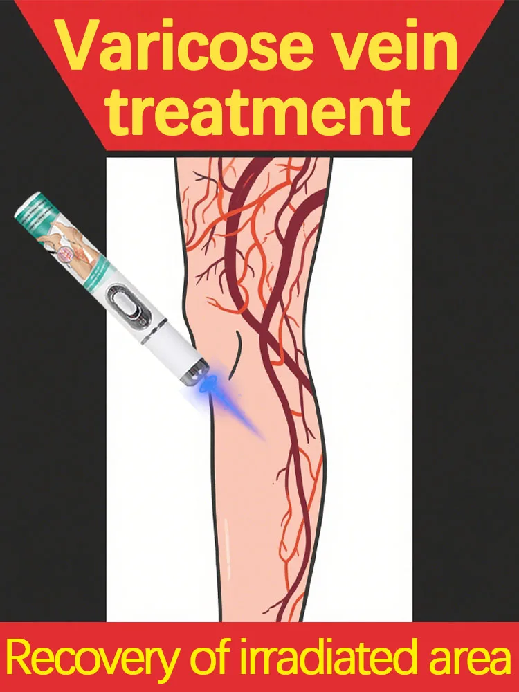 Effective treatment for varicose veins, relieves dilated vasculitis of leg phlebitis, avoids surgical pain
Effective treatment for varicose veins, relieves dilated vasculitis of leg phlebitis, avoids surgical pain