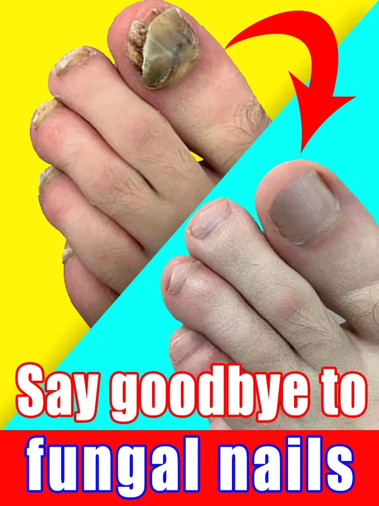 5 Days Nail Fungal Treatment Essence Oil Foot Toe Nail Fungus Removal Serum Repair Onychomycosi Anti Infection Care Products
5 Days Nail Fungal Treatment Essence Oil Foot Toe Nail Fungus Removal Serum Repair Onychomycosi Anti Infection Care Products