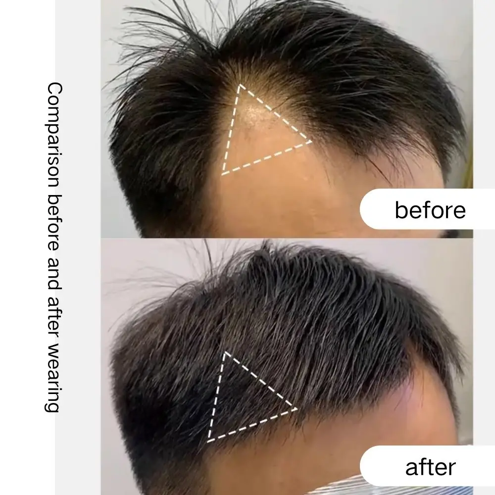 Накладка на лоб для маскировки волос, накладка на виски, накладка для маскировки шрамов, невидимый бесшовный ультратонкий парик из полиуретана для мужчин
Накладка на лоб для маскировки волос, накладка на виски, накладка для маскировки шрамов, невидимый бесшовный ультратонкий парик из полиуретана для мужчин