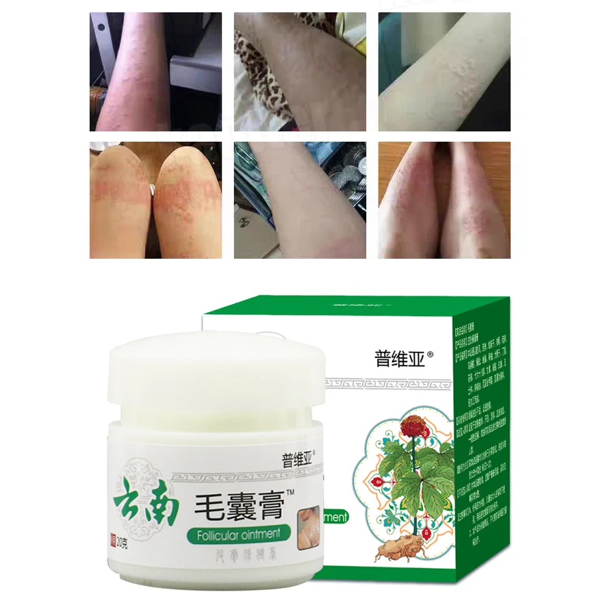 Body Acne Removal Cream Treatment Face Butt Back Marks Smooth Chicken Skin Cream Moisturizing Whitening Chinese Medicine 20g 
Body Acne Removal Cream Treatment Face Butt Back Marks Smooth Chicken Skin Cream Moisturizing Whitening Chinese Medicine 20g