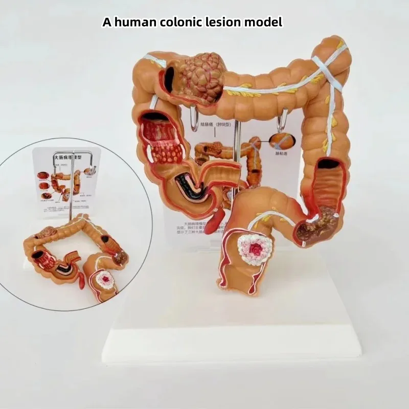 Human Colon Pathological Colorectal Cancer Large Intestine Gastrointestinal Anatomical Model
Human Colon Pathological Colorectal Cancer Large Intestine Gastrointestinal Anatomical Model