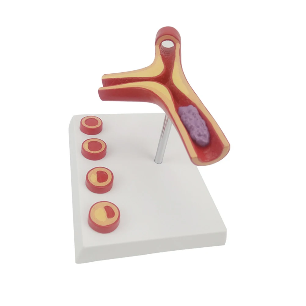 1 Pcs PVC Human Arterial Coronary Arteriosclerosis Atherosclerosis Coronary Model Cross Section Heart Disease Thrombus Model
1 Pcs PVC Human Arterial Coronary Arteriosclerosis Atherosclerosis Coronary Model Cross Section Heart Disease Thrombus Model
