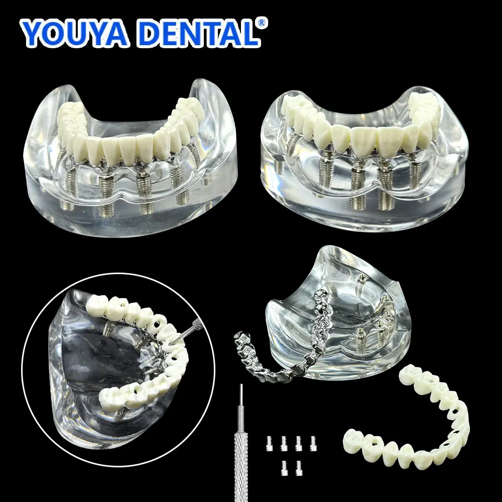 Dental Upeer Lower Tooth Implant Restoration Brige Maxillary Removable Overdenture Model With 6 Implants for Researching Medical
Dental Upeer Lower Tooth Implant Restoration Brige Maxillary Removable Overdenture Model With 6 Implants for Researching Medical