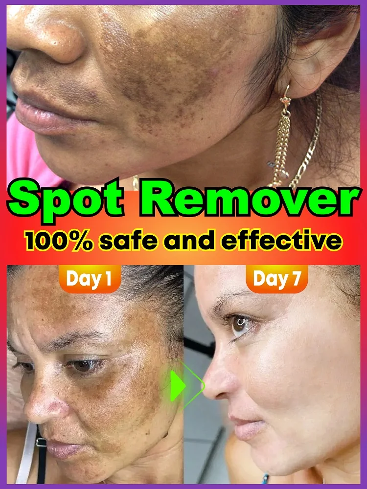 Brightening Dark Spot Remover - Targets Stubborn Spots, Evens Skin Tone, Non-Greasy, Suitable for Sensitive Skin
Brightening Dark Spot Remover - Targets Stubborn Spots, Evens Skin Tone, Non-Greasy, Suitable for Sensitive Skin
