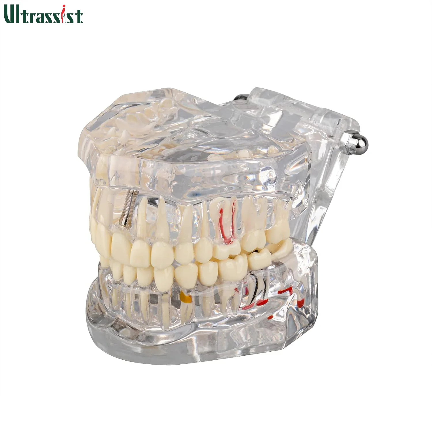 Ultrassist Transparent Disease Teeth Model Dental Maryland Bridge Decay Cyst Root Canal Acrylic Teeth for Student Teach Display
Ultrassist Transparent Disease Teeth Model Dental Maryland Bridge Decay Cyst Root Canal Acrylic Teeth for Student Teach Display