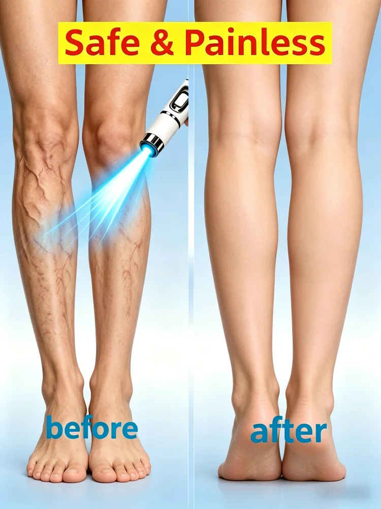 2026 Hot Sale,2-in-1 Varicose Vein,Household Leg Care Tool,Smooth Vessel Circulation,Improve Local Vessel Condition
2026 Hot Sale,2-in-1 Varicose Vein,Household Leg Care Tool,Smooth Vessel Circulation,Improve Local Vessel Condition